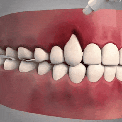 Stop Gum Recession and Bleeding Without Painful Surgery