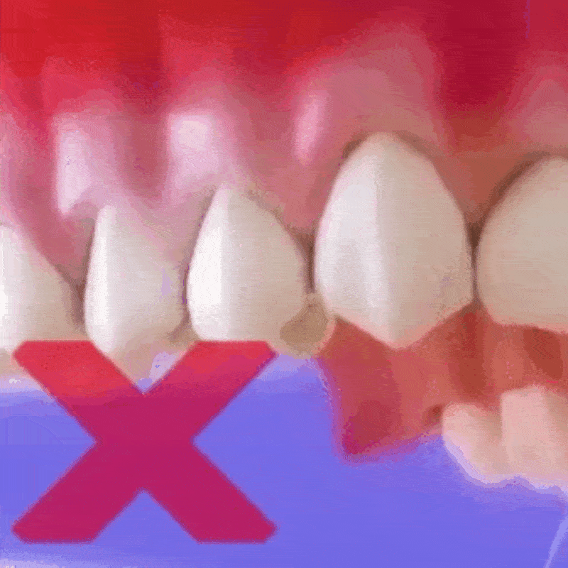 Stop Gum Recession and Bleeding Without Painful Surgery