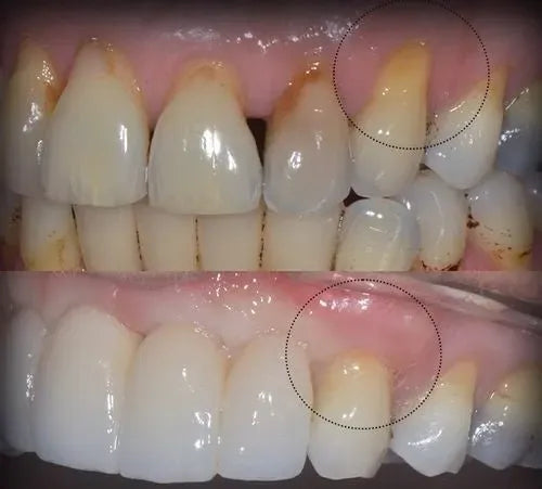 Stop Gum Recession and Bleeding Without Painful Surgery