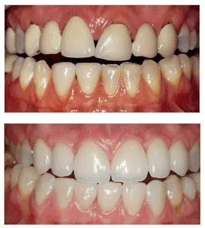 Stop Gum Recession and Bleeding Without Painful Surgery
